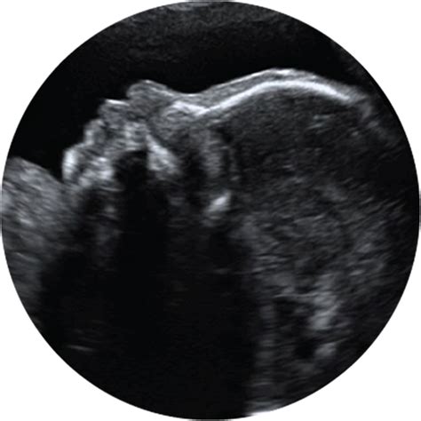 Collection Of Baby Ultrasound Png Pluspng