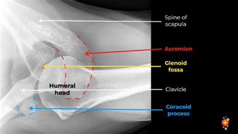 Shoulder X Ray Interpretation Laptrinhx News