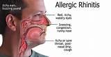 Images of Itchy Throat Allergy Treatment