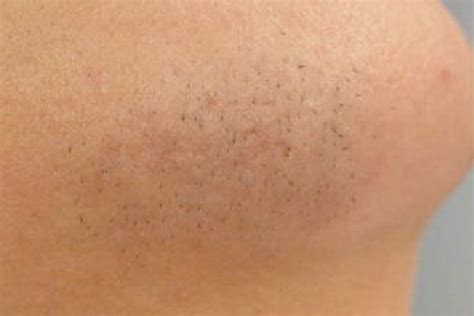 Laserhairremoval1a Ancaster Dermatology Ancaster Dermatology