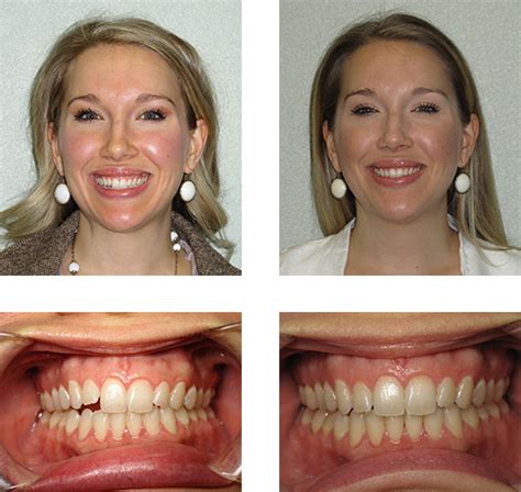 See more ideas about dermablend, makeup, fragrance free products. Invisalign® Before & After Photos - San Antonio TX | VK ...