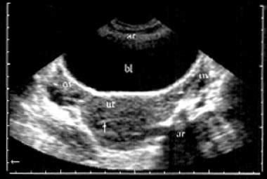 Pelvic floor ultrasound (pfus), one application of. Chronic Pelvic Pain in Women Workup: Laboratory Studies ...