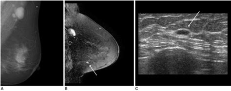A 53 Year Old Woman With Palpable Left Axillary Lymph Node Metastasis