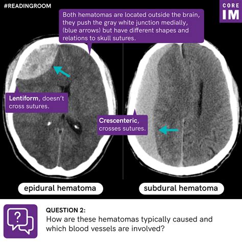Epidural Hematoma Radiology