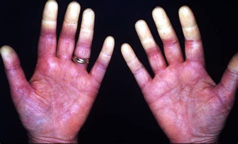 Case Study Raynauds Phenomenon Physician Assistant Boards