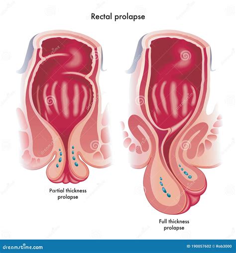 Rectal Prolapse Stock Illustrations Rectal Prolapse Stock Illustrations Vectors Clipart