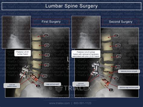 Lumbar Spine Surgery Trial Exhibits Inc