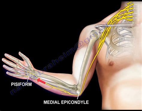 Ulnar Tunnel Syndrome The Ulnar Nerve Arises From The Medial By