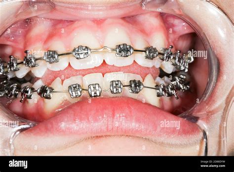 Close Up Ceramic And Metal Braces On Teeth Broad Smile With Self