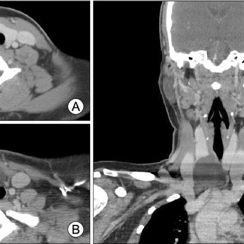 Ct Scans With Contrast Enhancement Shows 5×5 Cm Well Defined Cyst