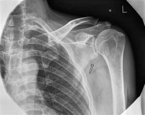 Figure 1 From Isolated Avulsion Fracture Of The Lesser Tuberosity Of
