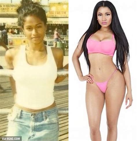 Nicki Minaj Before And After Surgery