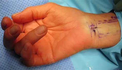 Endoscopic Carpal Tunnel Release Surgery For Carpal Tunnel Syndrome