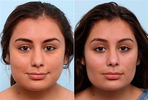 Buccal Fat Pad Removal Photos Houston Tx Patient 27803