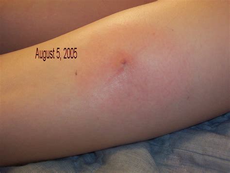 0001 Early Stage Of A Brown Recluse Spider Bite Stacy Mcnabb Flickr
