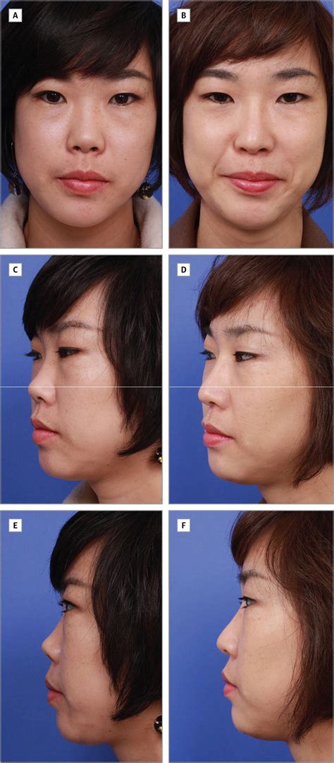 Lengthening The Short Nose In Asians Key Maneuvers And Surgical Results Jama Facial Plastic