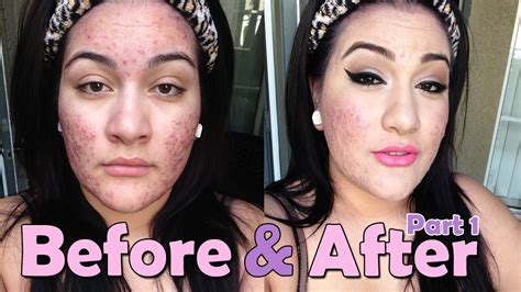Foundation Routine For Severe Acne Part One Youtube
