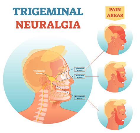 Understanding Trigeminal Neuralgia Symptoms Causes And Treatment