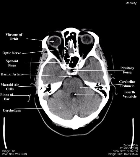Ct Scan Tips And Protocols Ct Brain Anatomy