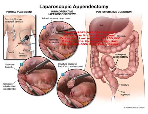 Amicus Illustration Of Amicus Surgery Appendix Appendectomy Laparoscopic Portal Placement Mm
