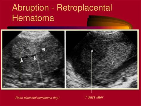 Ppt Bleeding Late In Pregnancy Powerpoint Presentation Free Download