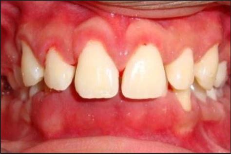 Chronic Inflammatory Gingival Enlargement Associated With Orthodontic
