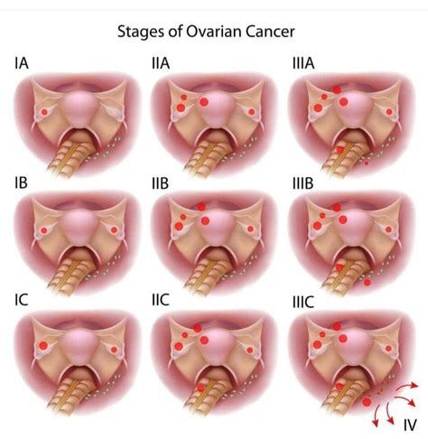 Pin On Ovarian Cancer Awareness