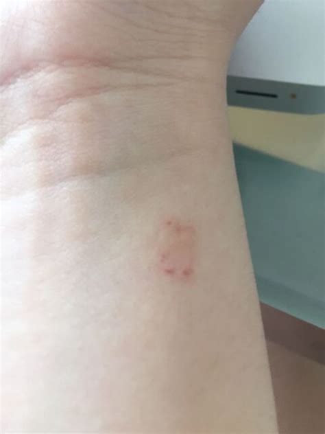 What Is This Allergy Wound Animal Bite Bug Bite Acne And Skin Dis