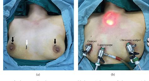 Figure From Comparison Of Conventional Open Thyroidectomy And