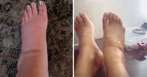 Swollen Feet During Pregnancy And Why It Happens Explained