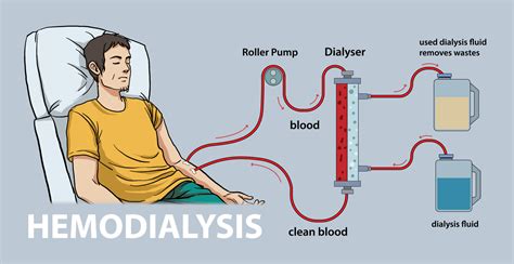 Illustration Of Hemodialysis Diagram 24318104 Vector Art At Vecteezy
