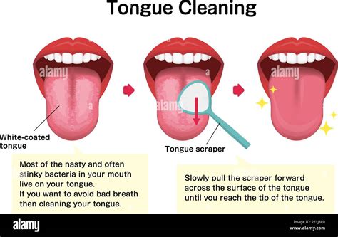 How To Clean Your Tongue Vector Illustration Halitosis Prevention