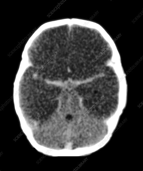 Diffuse Cerebral Oedema Stock Image M1080722 Science Photo Library