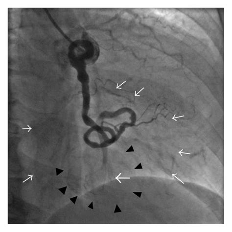 A Giant Coronary Artery Aneurysm With Coronary Arteriovenous Fistula In