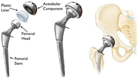 Hip Replacement Surgery Recovery How Long Does It Take To Recover