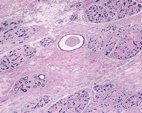 Fibrocystic Breast Change Light Micrograph Stock Image C0410294
