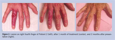 Neutrophilic Dermatosis Of The Dorsal Hand
