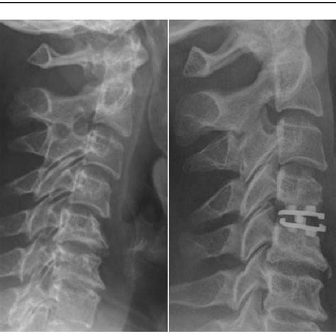 Pre And Post Operative Lateral Neutral Radiographs Demonstrating
