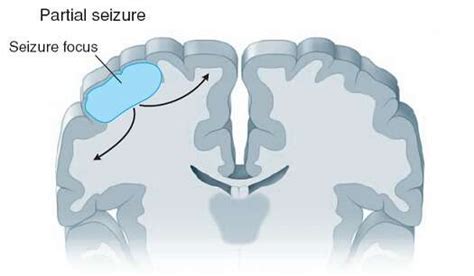 Web Site What Are The Symptoms Of Partial Focal Onset Seizures