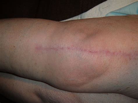Knee Replacement Scar Recovery Timeline A Photo Gallery