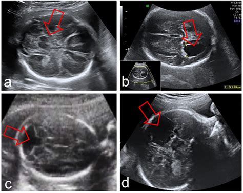 Outcome Of Fetuses With Abnormal Cavum Septi Pellucidi Experience Of A