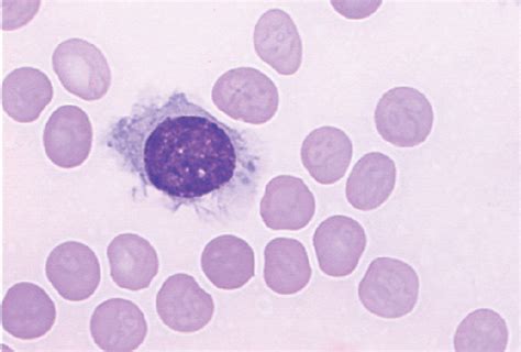 Advances In The Treatment Of Hairy Cell Leukaemia The