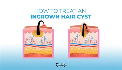 Ingrown Hair Cysts Treatments Causes And Symptoms Starpil Wax
