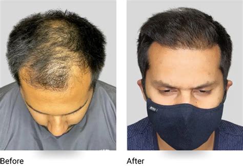 Fue Hair Transplant Services In Sydney Hair Doctors