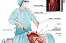 laparoscopy endometriosis procedure pelvic ovarian recovery surgery pain abdomen time operation contents used inside