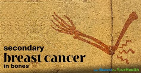 Breast, prostate and lung tumors most commonly it is important to follow up with your doctor regularly to look for signs that the cancer is coming back. Secondary Breast Cancer In Bone: - Health Solutions Plus