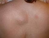 What Doctor To See For Lipoma Pictures