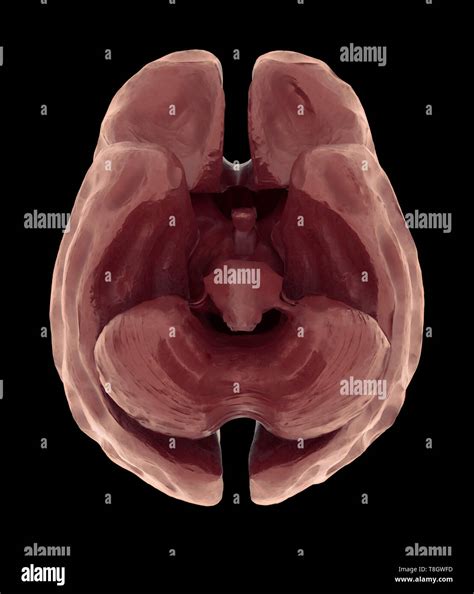 Brain Atrophy Or Severe Shrinkage Of The Brain Caused By Dementia And