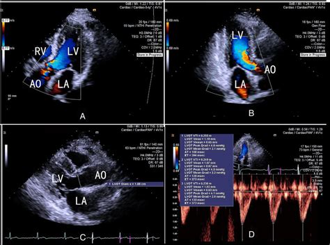 Co Assessment Using 2d Pwd Transthoracic Echocardiography Cardiac