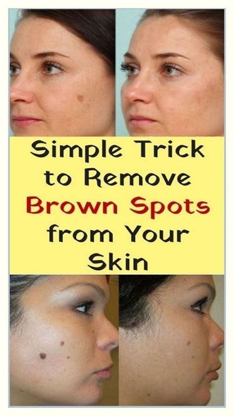 Simple Trick To Remove Brown Spots From Your Skin Brown Spots Removal
